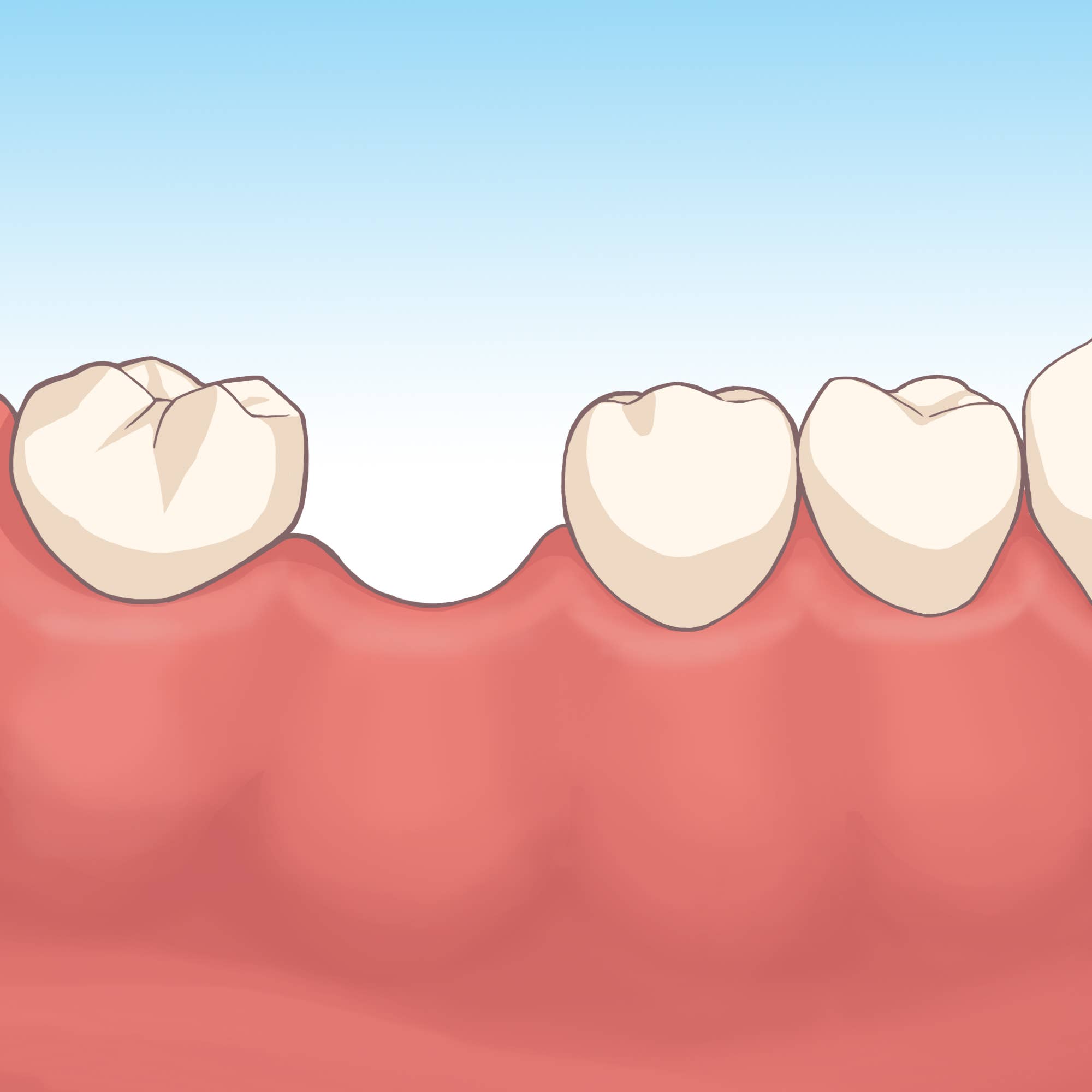 歯を失った際の治療方法について