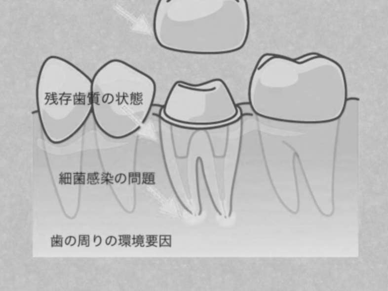 むし歯治療後の歯の寿命について